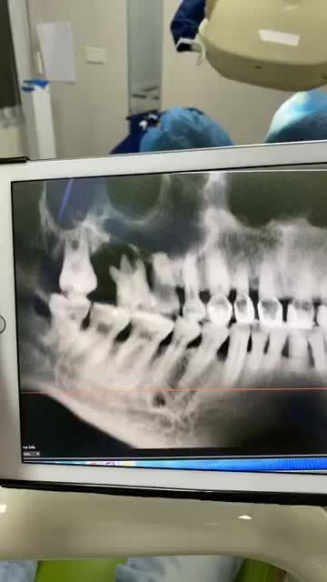 Cấy ghép implant răng hàm cho bệnh nhân nam 35 tuổi đến từ Hoà Bình.