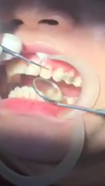 GẮN MẮC CÀI NIỀNG RĂNG ĐIỀU TRỊ RĂNG HÔ tại Nha Khoa Vân Anh !!!