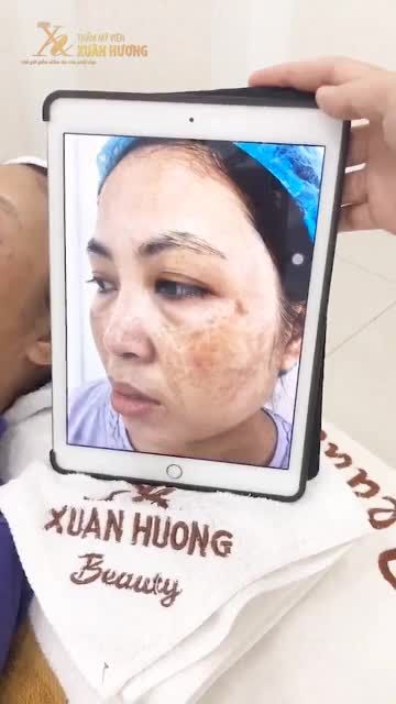 KHÔNG THỂ TIN ĐƯỢC LÀN DA KÍN NÁM LẠI TRẮNG MỊN CHỈ SAU 5 BUỔI MELAS PICOSURE