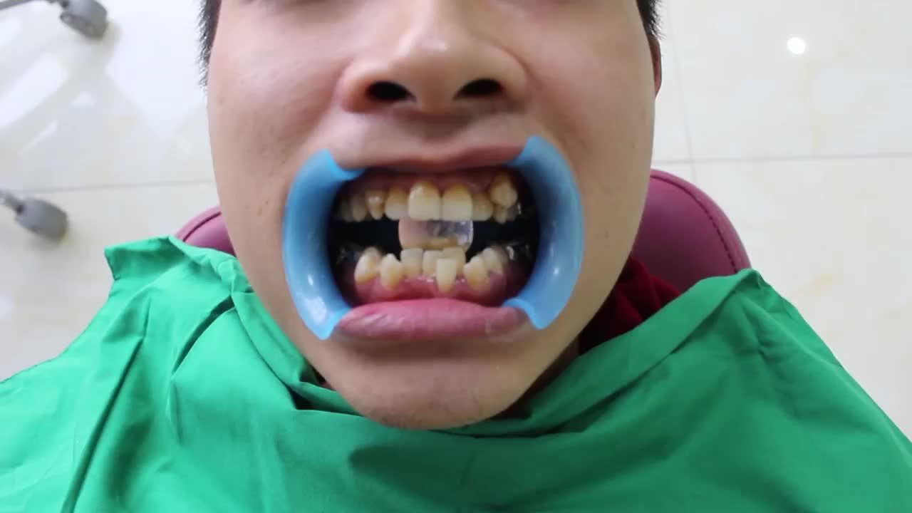 NIỀNG RĂNG MẮC CÀI PHA LÊ - THOẢI MÁI TỰ TIN NÓI CƯỜI