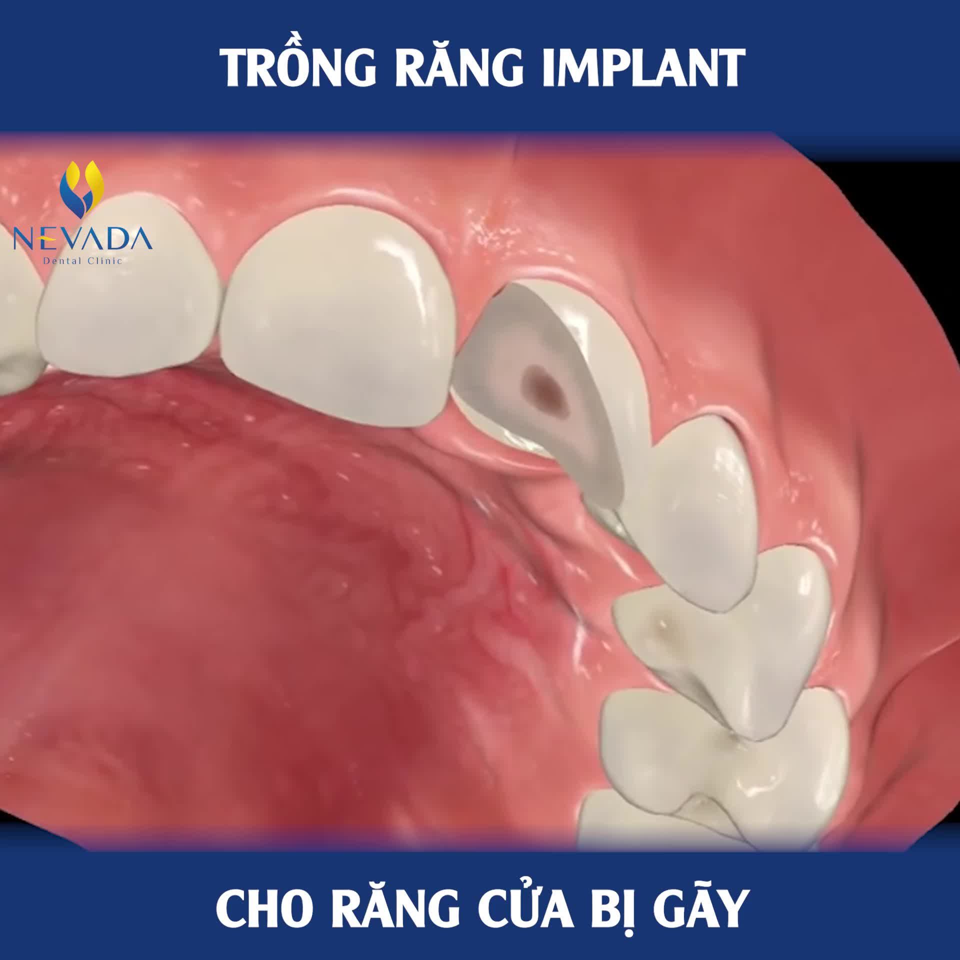 RĂNG CỬA BỊ GÃY PHẢI LÀM SAO?