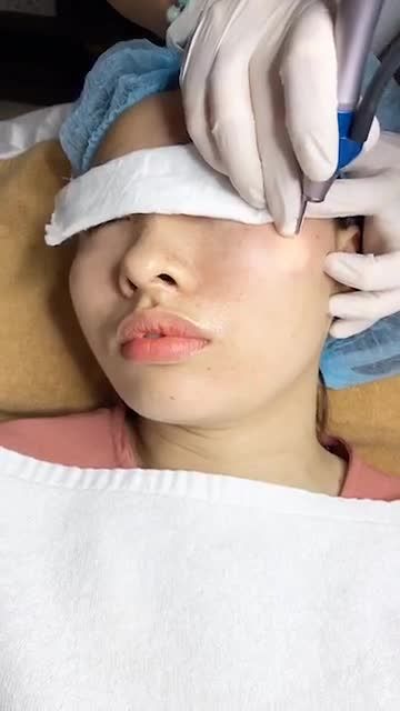 MỤN THỊT QUANH MẮT Đánh bay hoàn toàn dễ dàng với Laser CO2 Fractional