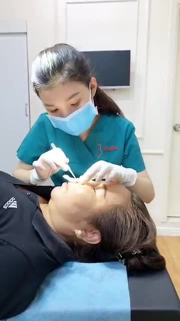 Cắt chỉ mũi sau 2 tuần thực hiện nâng mũi siêu cấu trúc