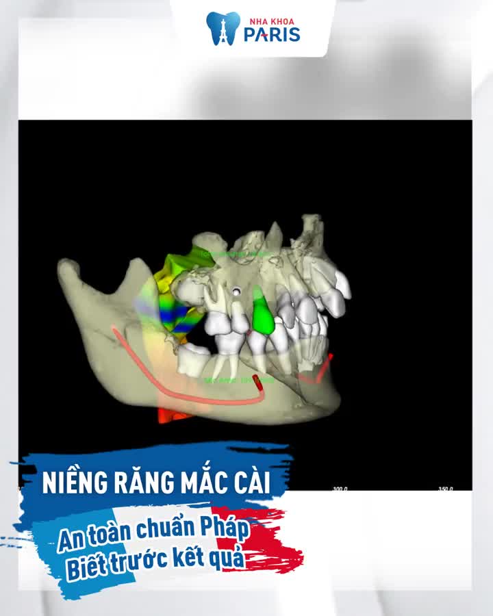 HÔ - MÓM - THƯA - KHẤP KHỂNH NIỀNG RĂNG MẮC CÀI - BIẾT TRƯỚC KẾT QUẢ