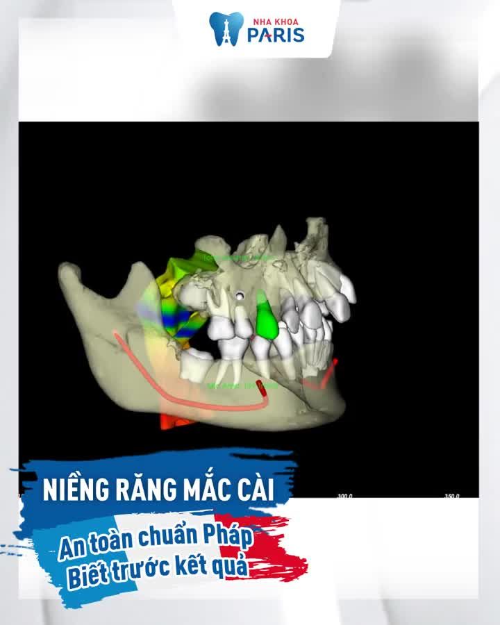 HÔ - MÓM - THƯA - KHẤP KHỂNH NIỀNG RĂNG MẮC CÀI - BIẾT TRƯỚC KẾT QUẢ