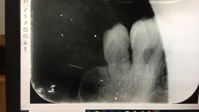 Nhổ răng khôn mọc lệch dị dạng cho anh Phú.