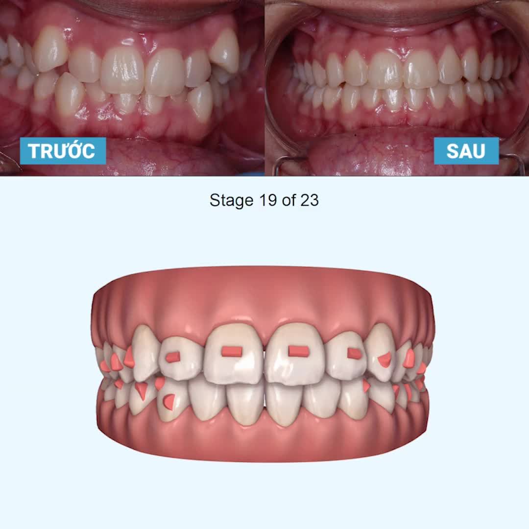 Răng khấp khểnh thay đổi kỳ diệu chỉ trong 11 tháng với máng Invisalign