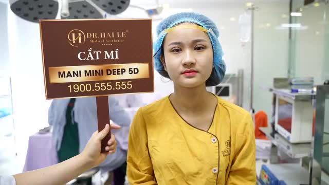 Kết quả cắt mí Mani Mini Deep 5D đẹp rạng ngời ít sưng nề, ít đau, kết quả hoàn thành đẹp ưng ý chỉ sau 45 phút thực hiện - Mời quý khách hàng cùng theo dõi!