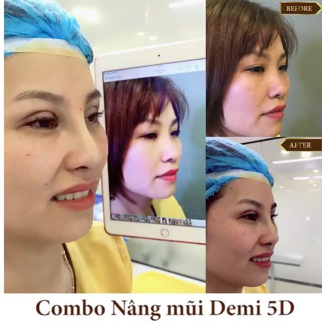 COMBO NÂNG MŨI + CẮT MÍ