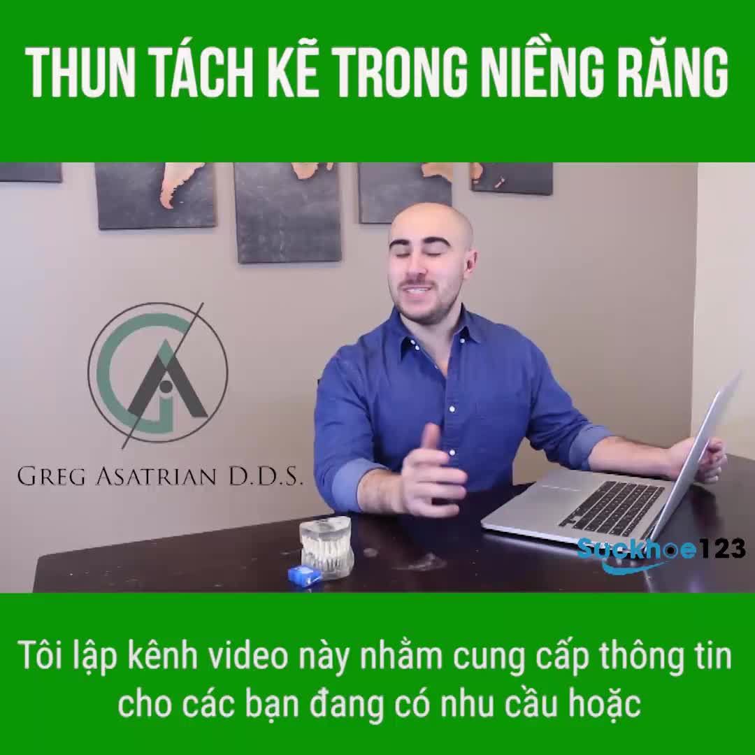 Thun tách kẽ trong niềng răng