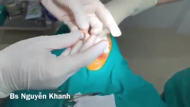 Bao xơ quanh mũi là gì