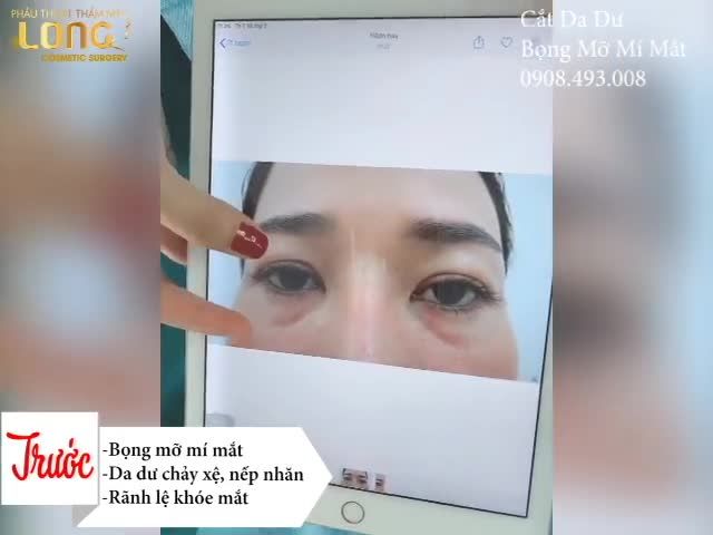 Chỉ thẩm mỹ đôi mắt đã có thể "Trẻ Hoá Gương Mặt"