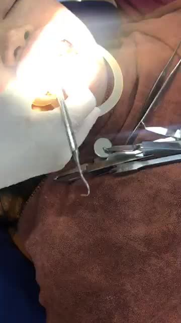 GẮN MẮC CÀI NIỀNG RĂNG ĐIỀU TRỊ RĂNG HÔ VÀ THƯA tại Nha Khoa Vân Anh