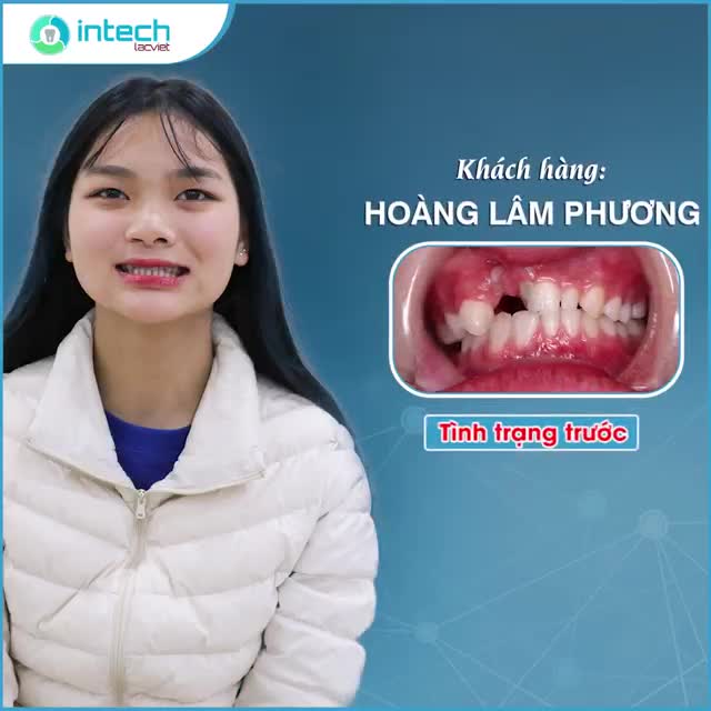 Lý do nào khiến cô gái 15 tuổi lặn lội qua nhiều phòng khám từ Hà Giang về Tuyên Quang, Hà Nội và cuối cùng chọn Lạc Việt Intech để thay đổi nụ cười