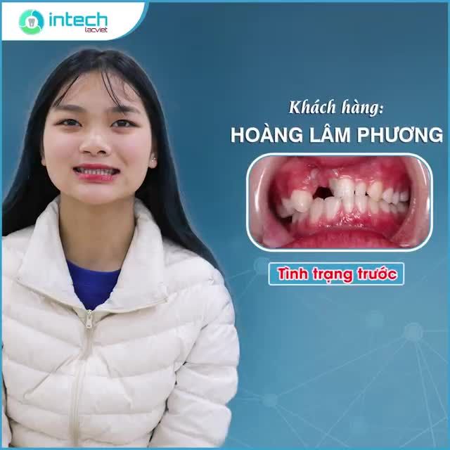 Lý do nào khiến cô gái 15 tuổi lặn lội qua nhiều phòng khám từ Hà Giang về Tuyên Quang, Hà Nội và cuối cùng chọn Lạc Việt Intech để thay đổi nụ cười