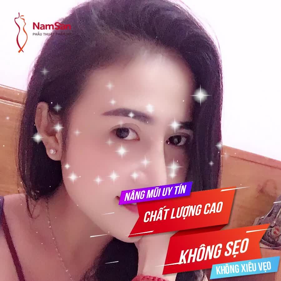 MŨI ĐẸP KHÔNG SẸO, KHÔNG SIÊU VẸO