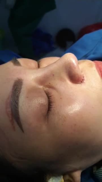 Nâng mũi bán cấu trúc đa lớp