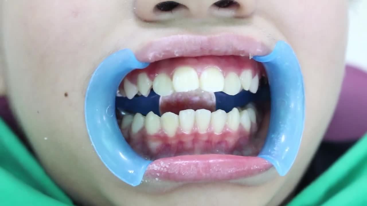 NIỀNG RĂNG THẨM MỸ GIẢI PHÁP MANG LẠI HÀM RĂNG ĐỀU ĐẸP!