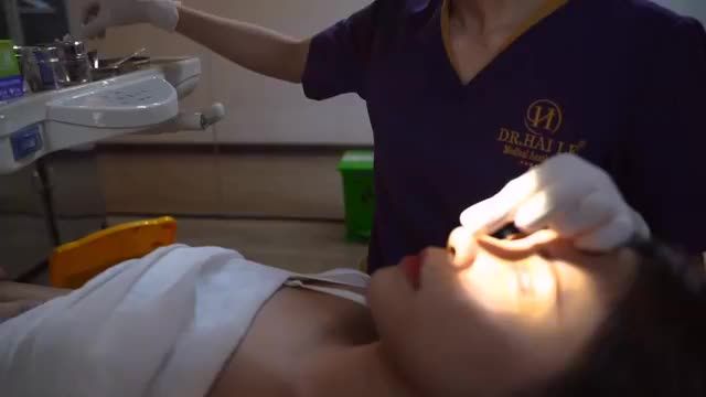 Cận cảnh 1 ca cắt chỉ Combo Nâng mũi  Cắt mí, kết quả đẹp hoàn hảo đến chính khách hàng cũng bất ngờ