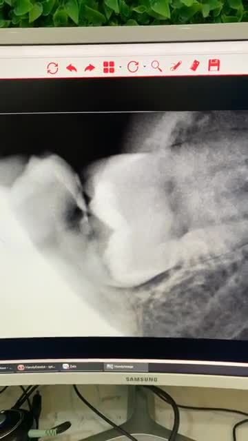 Nhổ 2 răng khôn mọc ngầm đâm thẳng răng số 7, răng mọc sát dây thần kinh.... Khách hàng cảm nhận như thế nào ngay sau khi nhổ. Xem livestream để khám phá