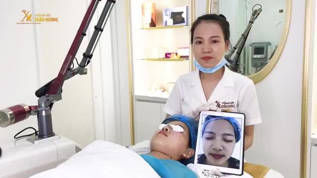 THOÁT CẢNH TÀN NHANG KÍN MÁ CHỈ SAU 1 LẦN ĐIỀU TRỊ DUY NHẤT