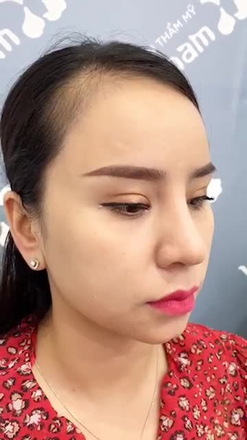Kết quả nâng mũi na