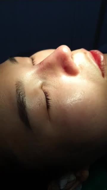 Nâng mũi bán cấu trúc đa lớp