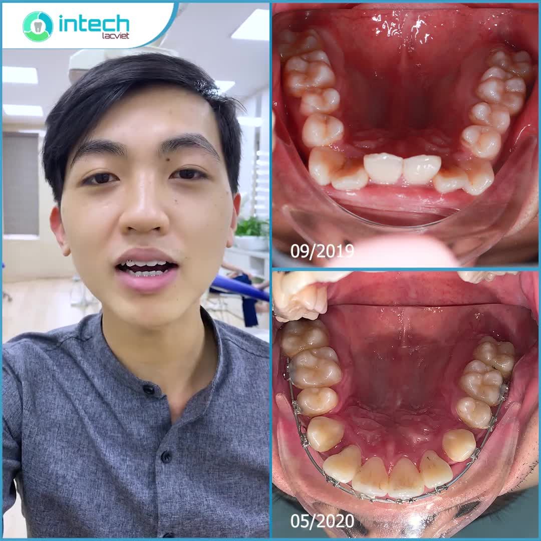 NGỠ NGÀNG TRƯỚC SỰ THAY ĐỔI CHỈ SAU 8 THÁNG NIỀNG RĂNG