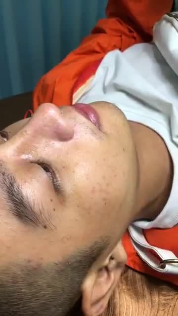 Tái khám cắt chỉ dáng mũi nam thần