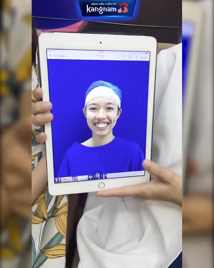 Chiêm ngưỡng kết quả mĩ mãn sau 5 tháng CHỈNH HÀM HÔ + CƯỜI HỞ LỢI