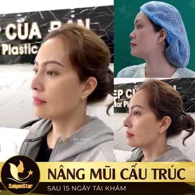 MŨI CẤU TRÚC SAU 15 NGÀY TÁI KHÁM