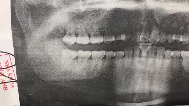 Nhổ 2 răng không 18,48