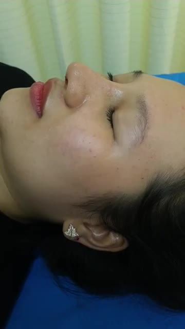 Nâng mũi bán cấu trúc sau 10 ngày
