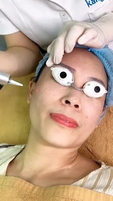 CASE ĐIỀU TRỊ BỚT OTA khắp mặt bằng LASER
