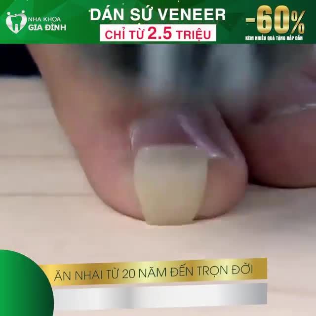 DÁN SỨ VENEER: SIÊU MỎNG – SỐNG ĐỘNG – BỀN CHẮC