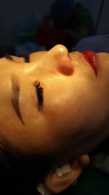 Nâng mũi sụn tai 2 lớp Dáng Sline tự nhiên Đầu mũi tròn, phong thủy Quá đẹp cho em gái Kiên Giang