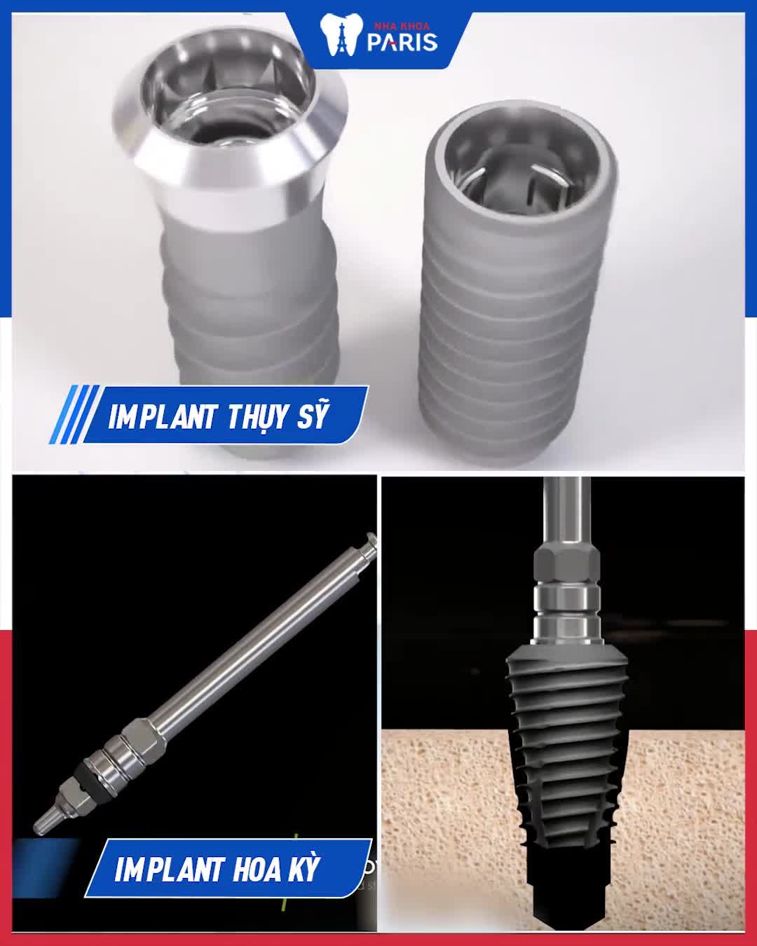 MẤT RĂNG? TRỒNG RĂNG VĨNH VIỄN CHỈ TỪ 12 TRIỆU