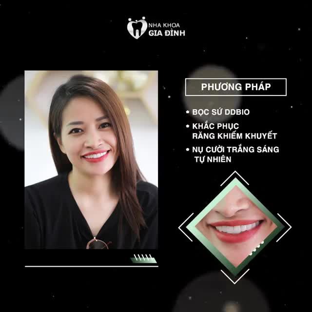 THẨM MỸ RĂNG ƯU ĐÃI 60% CHỈ TỪ 2TR/RĂNG