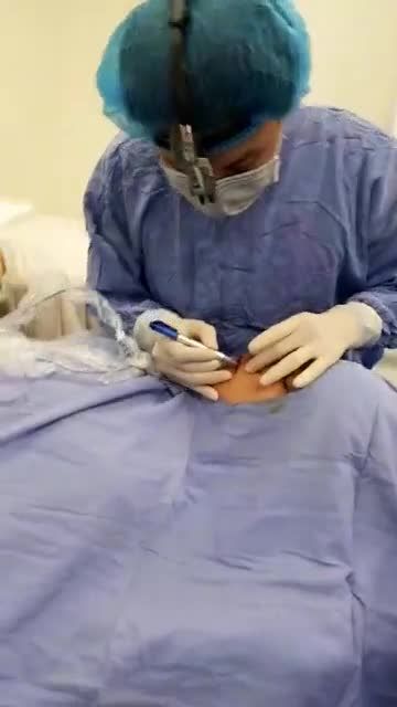 Thu mỏng môi trên cũ trên nền môi sẹo của khách hàng nam