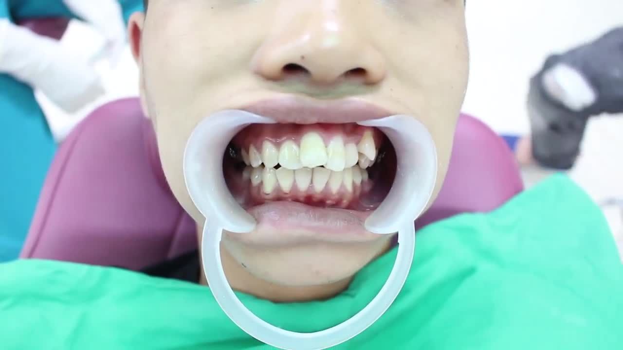 CƠN BÃO ƯU ĐÃI VỀ NGẬP NHA KHOA RỒI MỌI NGƯỜI ƠI