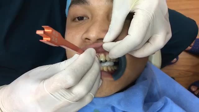 GẮN MẮC CÀI TẠI NHA KHOA THÙY ANH.