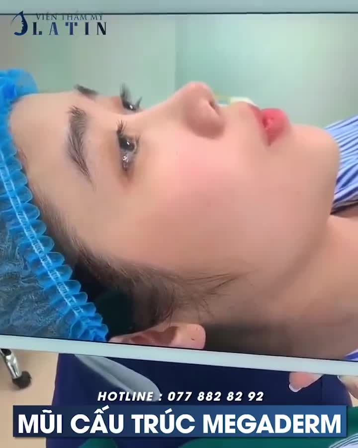MŨI CẤU TRÚC VỪA HOÀN THÀNH CHO EM GÁI LONG XUYÊN