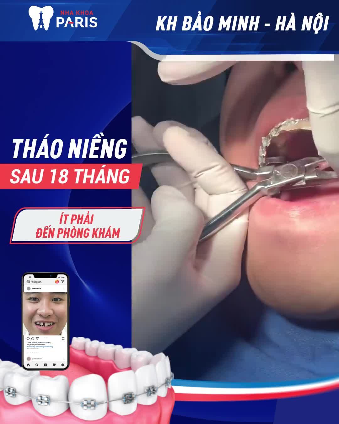 Nam Thanh Niên Hà Nội " Cười Đẹp Chuẩn Soái Ca" sau NIỀNG RĂNG