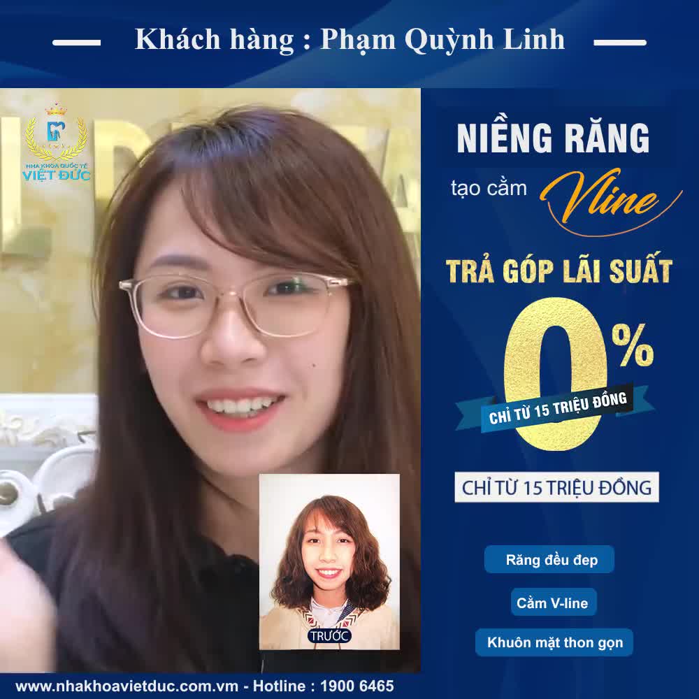 NIỀNG RĂNG TẠO CẰM VLINE GIÁ HẤP DẪN NHẤT TRẢ GÓP LÃI SUẤT 0%