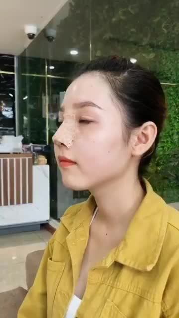 TÁI KHÁM SAU 3 NGÀY SỬA MŨI CHƯA ƯNG Ý BẰNG CÔNG NGHỆ NÂNG MŨI CẤU TRÚC SỤN SURGIFORM
