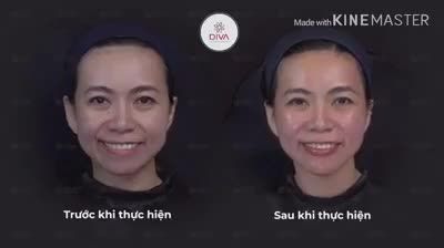 TIÊM FILLER NHƯ THẾ NÀO ĐỂ MẶT KHÔNG NHÌN SƯNG PHÙ ?