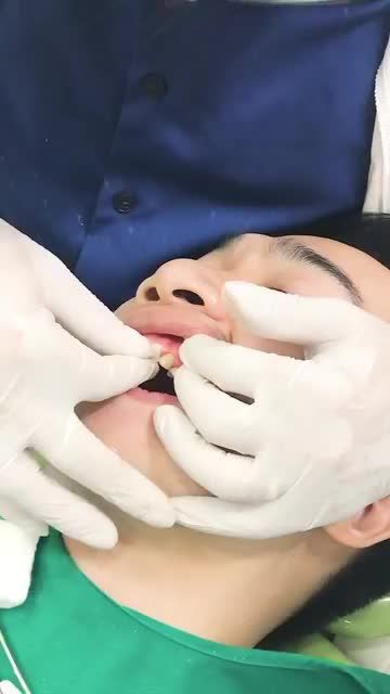 THẨM MỸ 18 VENEER SỨ CHO CA SĨ TIẾN HƯNG tại Nha khoa Gia Đình chi nhánh Tô Hiến Thành.