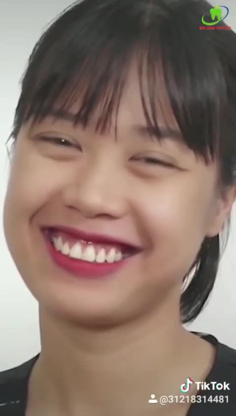 ĐIỀU TRỊ CƯỜI HỞ LỢI - VẼ NỤ CƯỜI DUYÊN CHỈ SAU 30 PHÚT