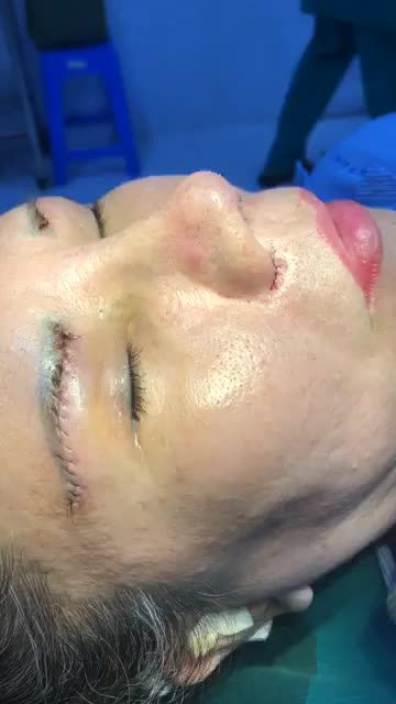 Nâng Mũi Bán Cấu Trúc Sụn Tai 2 Lớp + Thu Cánh Mũi Plasma+ Bóp nhỏ đầu mũi