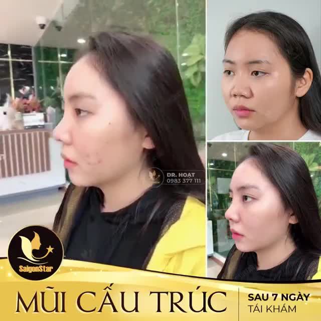 MŨI CẤU TRÚC SAU 7 NGÀY TÁI KHÁM